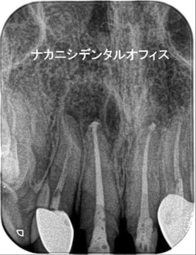精密根管治療 症例3