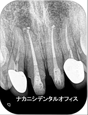 精密根管治療 症例4