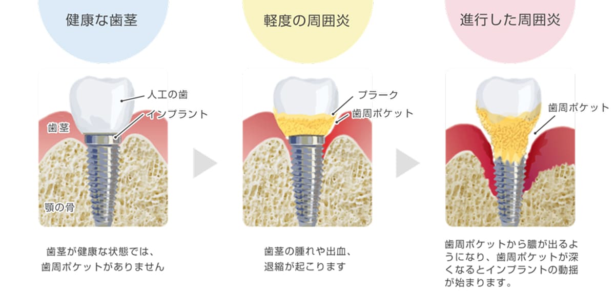 インプラント周囲炎の進行