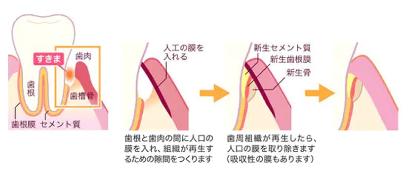 GTR法
